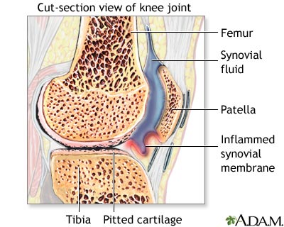 Sinovita articulației genunchiului